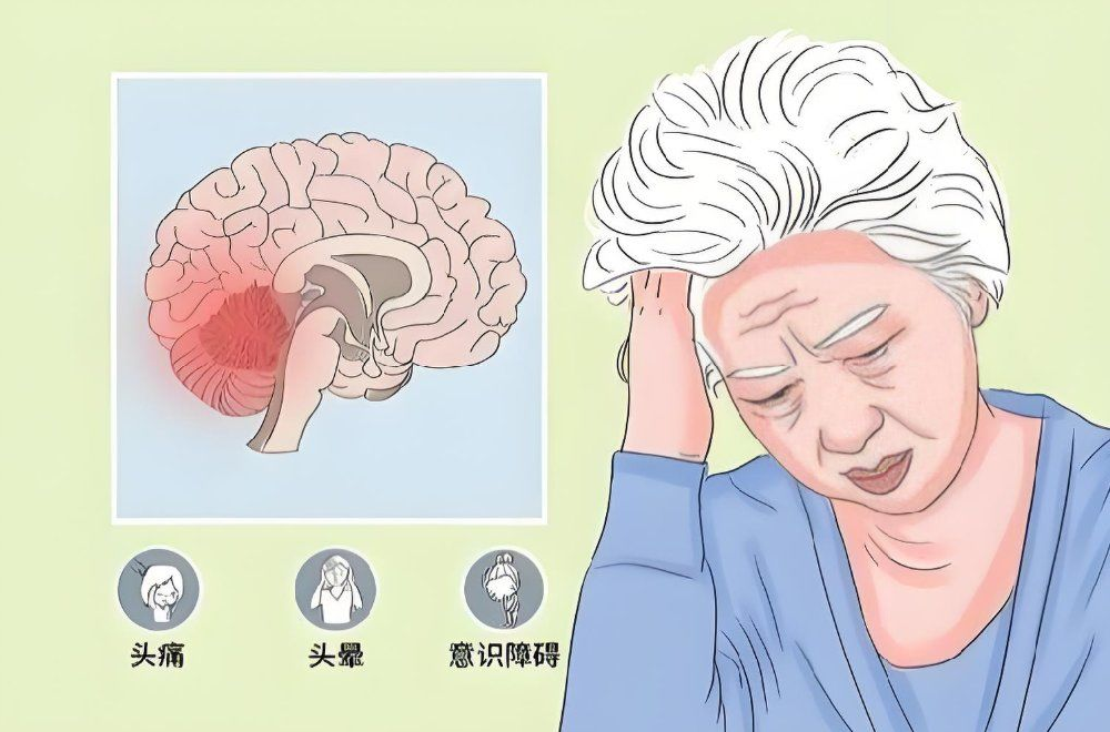 大脑萎缩、小脑萎缩,哪个才是老年痴呆?