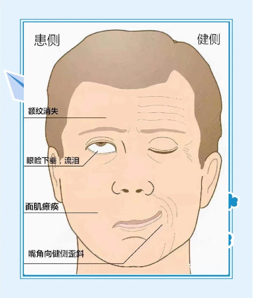 面瘫恢复有5个好转信号,出现任意一个,说明神经正在慢慢修复