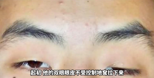 【康复案例】用药两年不见效!10岁患儿眼睑下垂、眼球流动障碍,神经修复综合治疗让其双眼灵动如初_重症肌无力康复记实