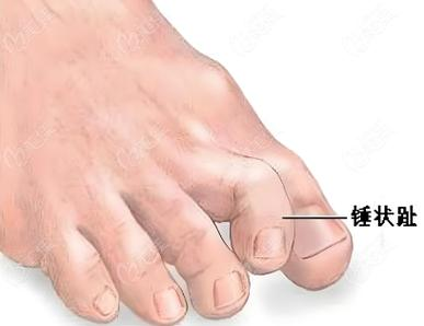 糖尿病周围神经病变早期5大信号,千万别忽视!