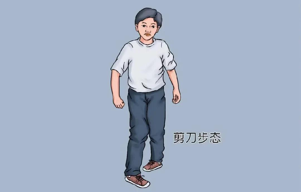 走路姿势藏着神经健康密码,带你认识神经内科最常见的五种异常步态