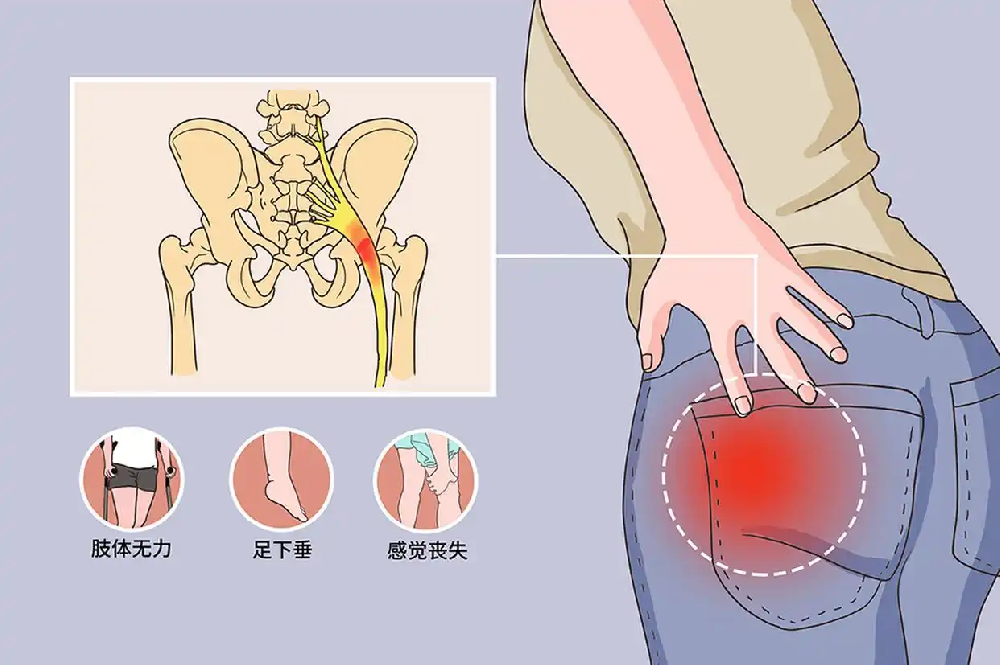 腰痛难恢复？出现这些症状，当心马尾神经损伤找上门