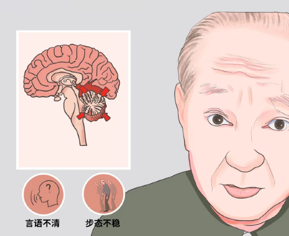 小脑萎缩会持续加重吗？别掉以轻心！日常护理抓准这几点