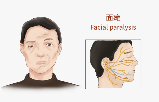 在线答疑:面瘫拖延三个月不见效,是不是进入后遗症期?